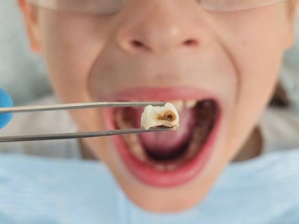 Best Emergency Wisdom Teeth Removal in Lucedale, MS